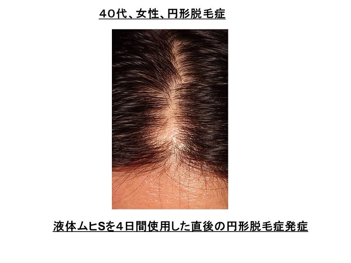 円形脱毛症　病院""